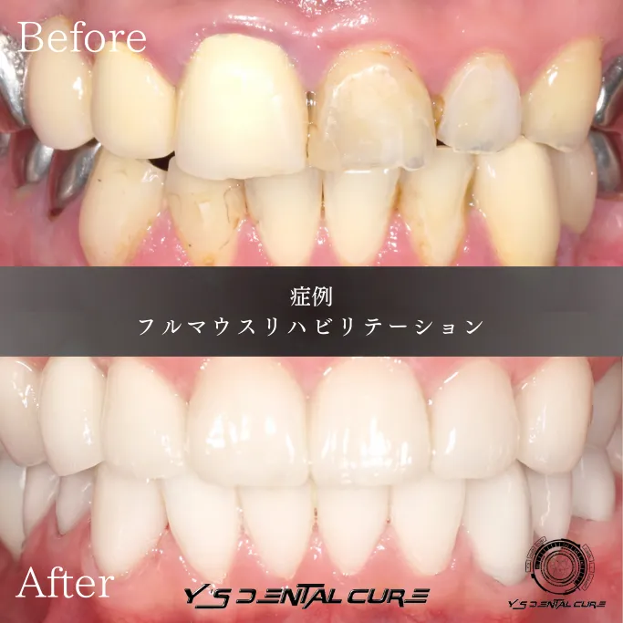 フルマウスリハビリテーション