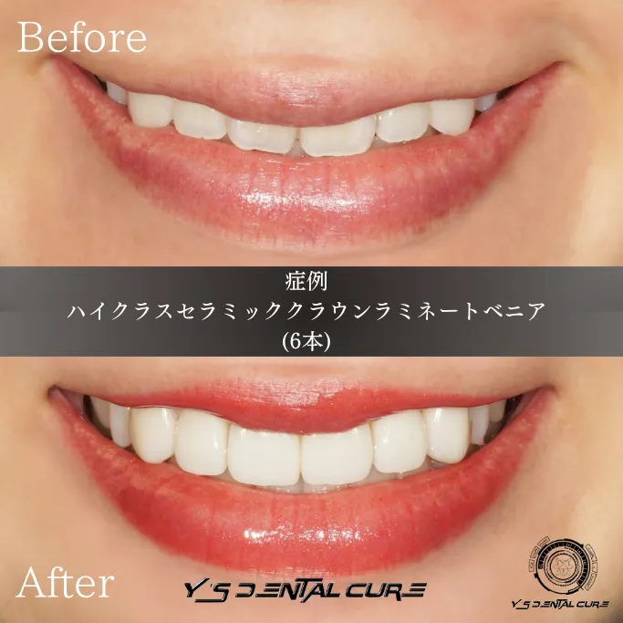 ハイクラスセラミッククラウンラミネートベニア