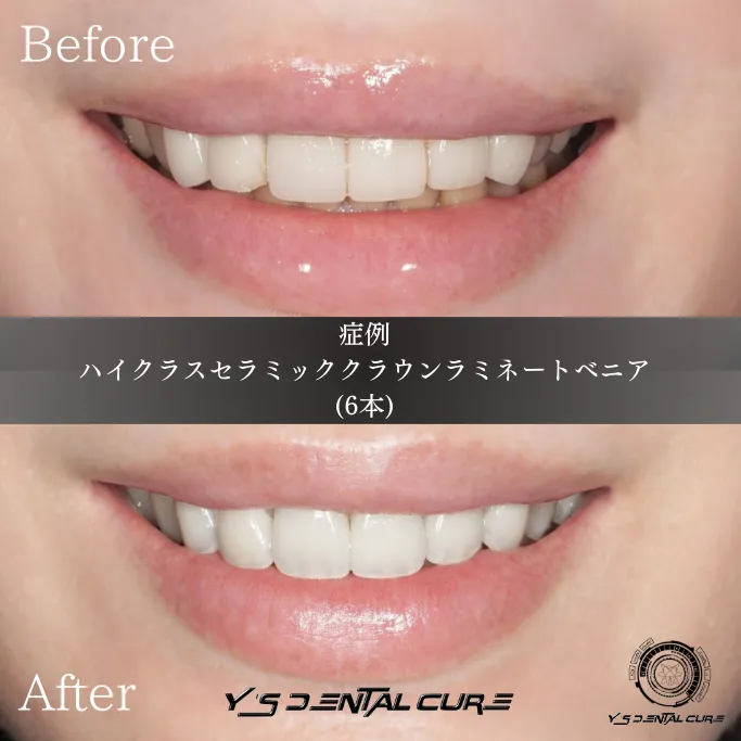 審美歯科の進化で導く再治療セラミック