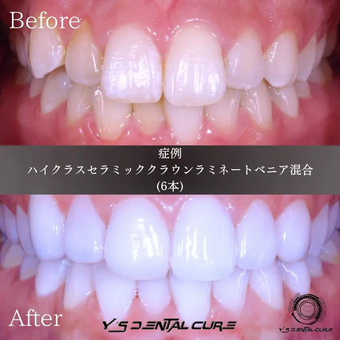セラミック治療から5年後の経過を解説