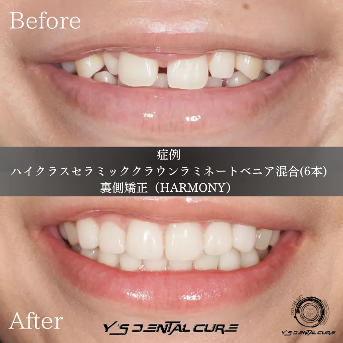 マウスピース矯正×セラミックで叶う口元のアップデート