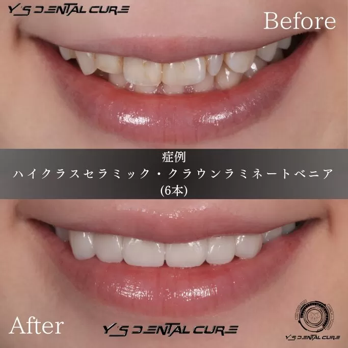 ハイクラスセラミック・クラウンラミネートべニア