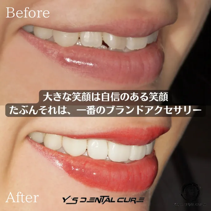 ハイクラスセラミッククラウンラミネートベニア