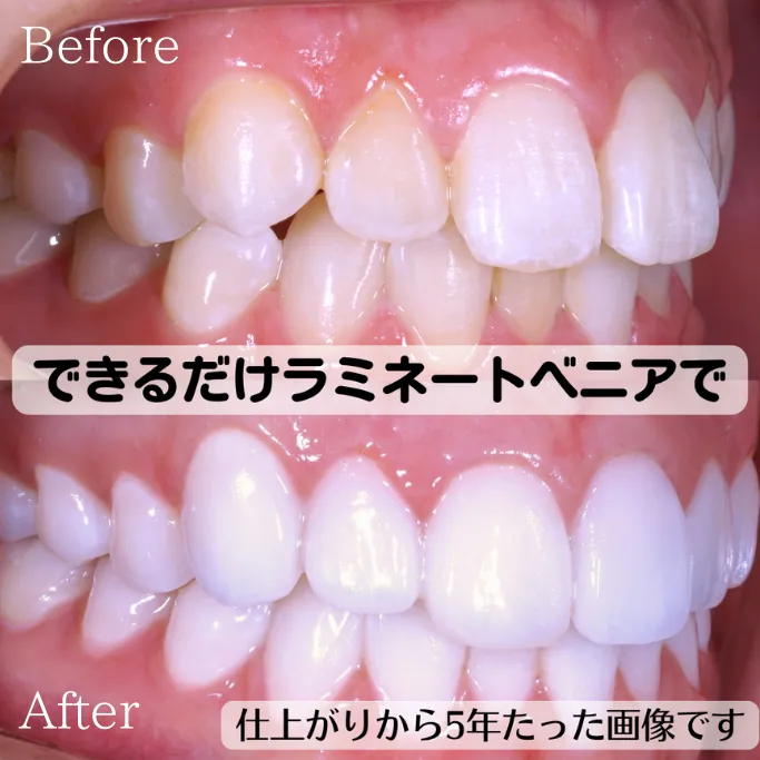 ハイクラスセラミッククラウンラミネートベニア混合の症例
