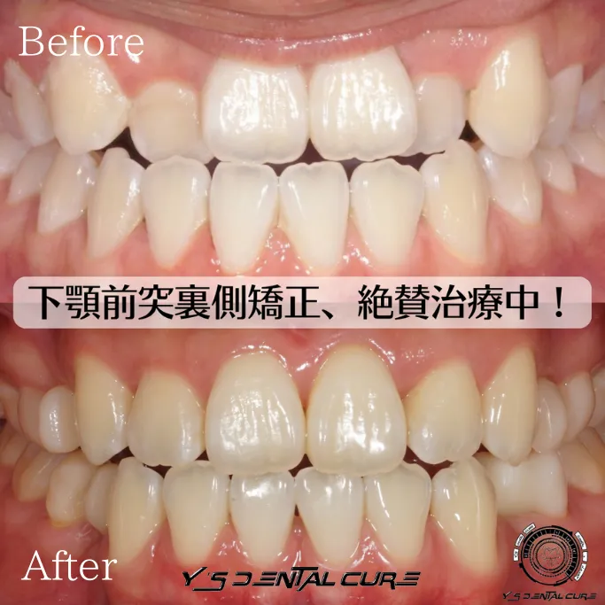 反対咬合を治す！裏側矯正で叶える自信ある笑顔