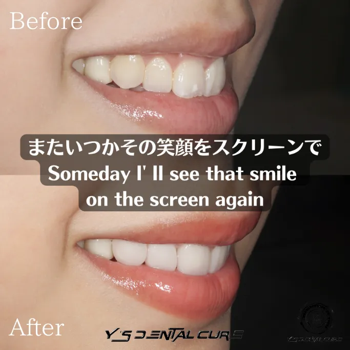 ハイクラスセラミッククラウンラミネートベニア