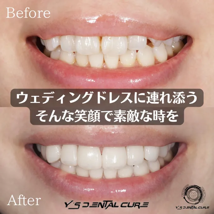 ハイクラスセラミッククラウンラミネートベニア混合の症例