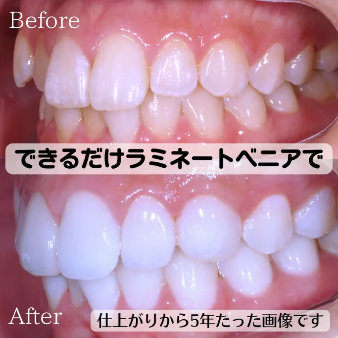 ハイクラスセラミッククラウンラミネートベニア混合の症例