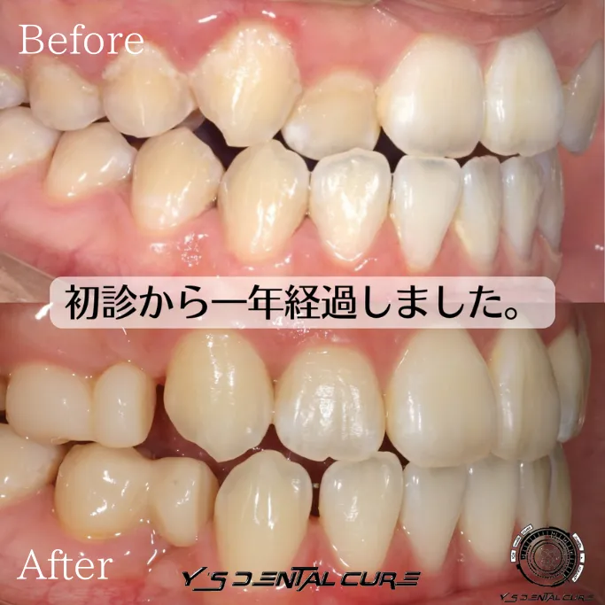 裏側矯正の症例