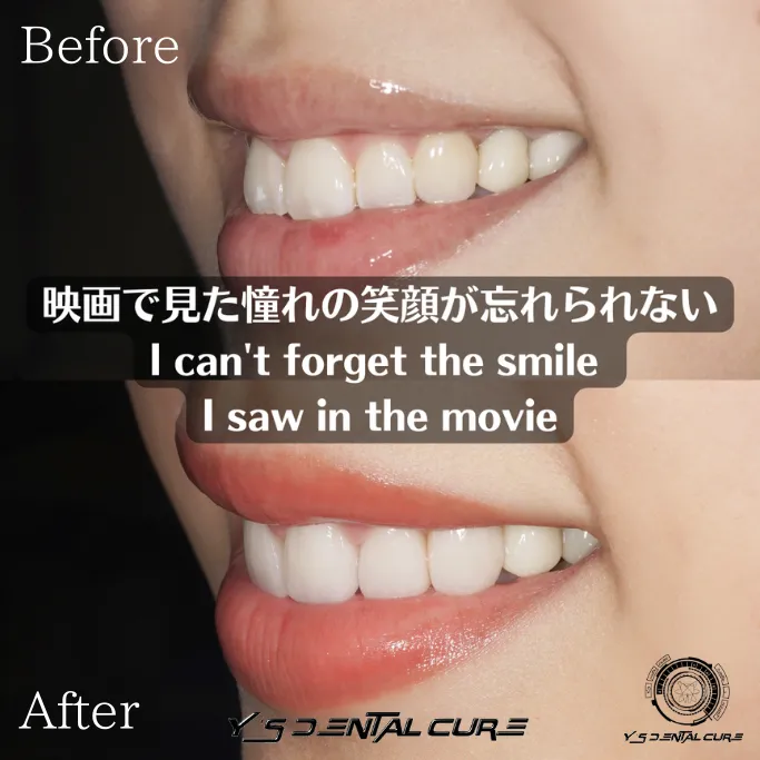 ハイクラスセラミッククラウンラミネートベニア