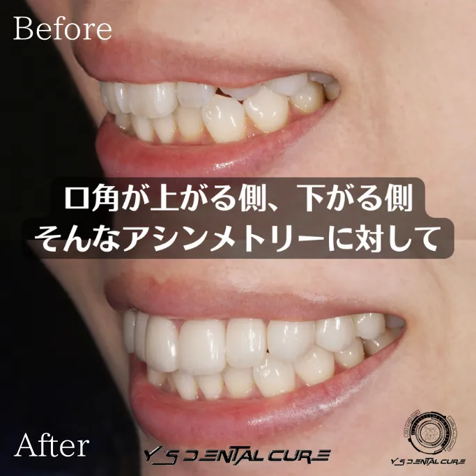 ハイクラスセラミッククラウンラミネートベニア混合の症例