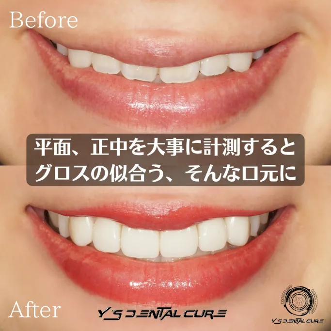 ハイクラスセラミッククラウンラミネートベニア