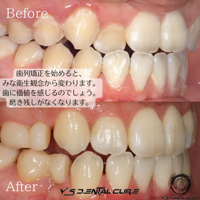 裏側矯正の症例