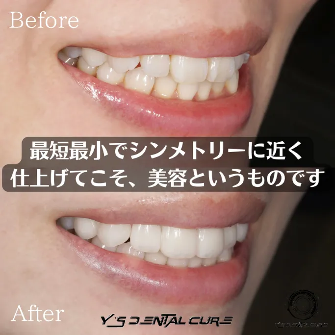 ハイクラスセラミッククラウンラミネートベニア混合の症例