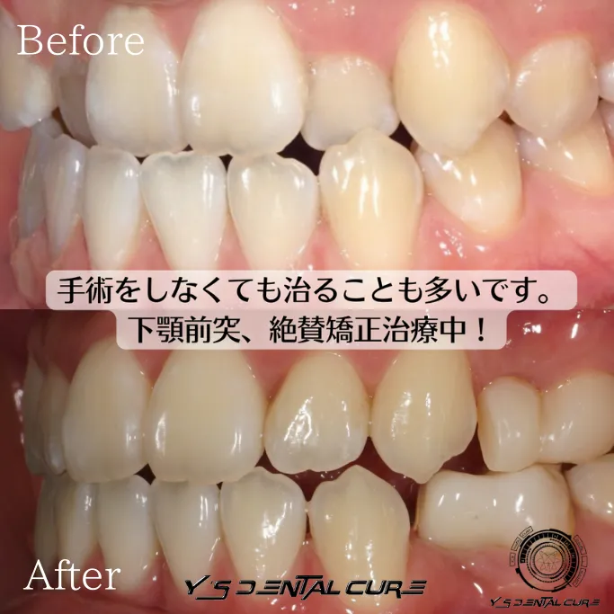 裏側矯正の症例