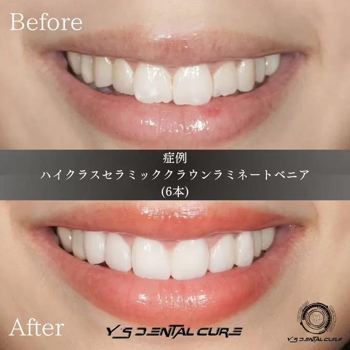 歯列矯正での後戻り