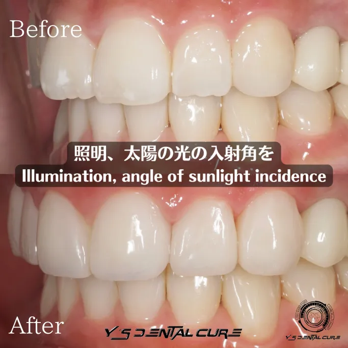 ハイクラスセラミッククラウンラミネートベニア