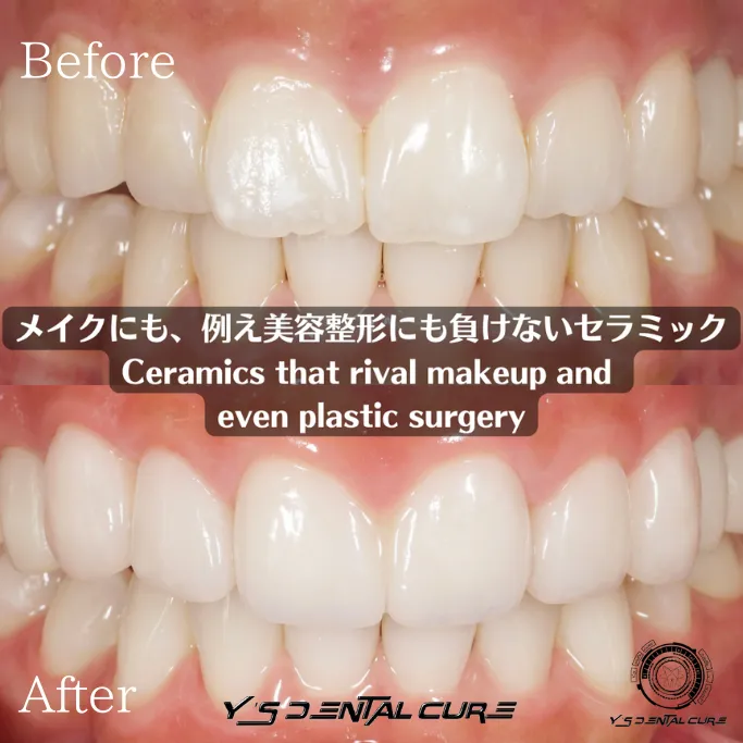 ハイクラスセラミッククラウンラミネートベニア